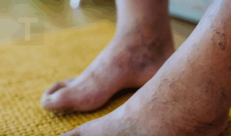 Τι κρύβεται πίσω από το μωβ χρώμα στα πόδια σας; Αιτίες που δεν πρέπει να αγνοήσετε