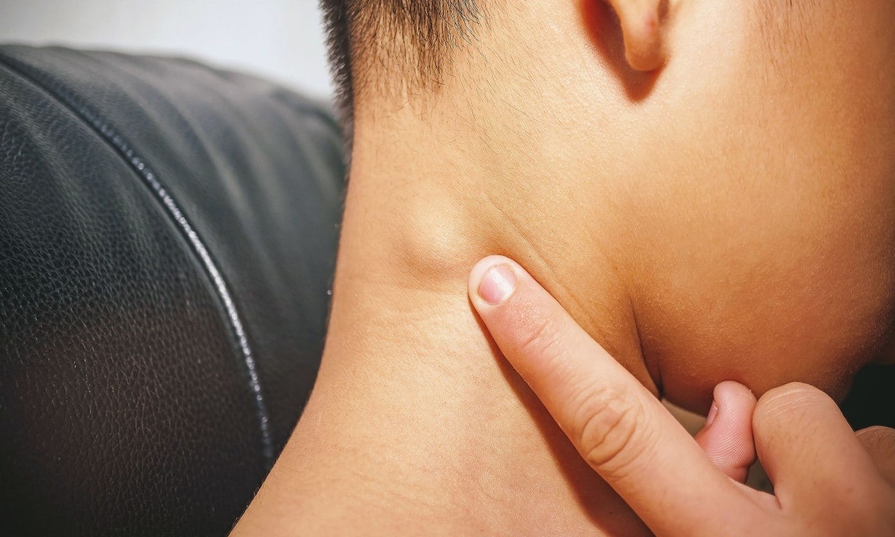 54a84f12 bigstock lymph node inflammation of the 254590171