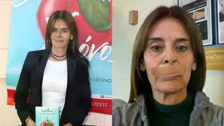 Πλουμιδάκη: Υποβλήθηκε στο 21ο χειρουργείο – «Πήραν λίπος από τον γλουτό για τη συγκεκριμένη επέμβαση»