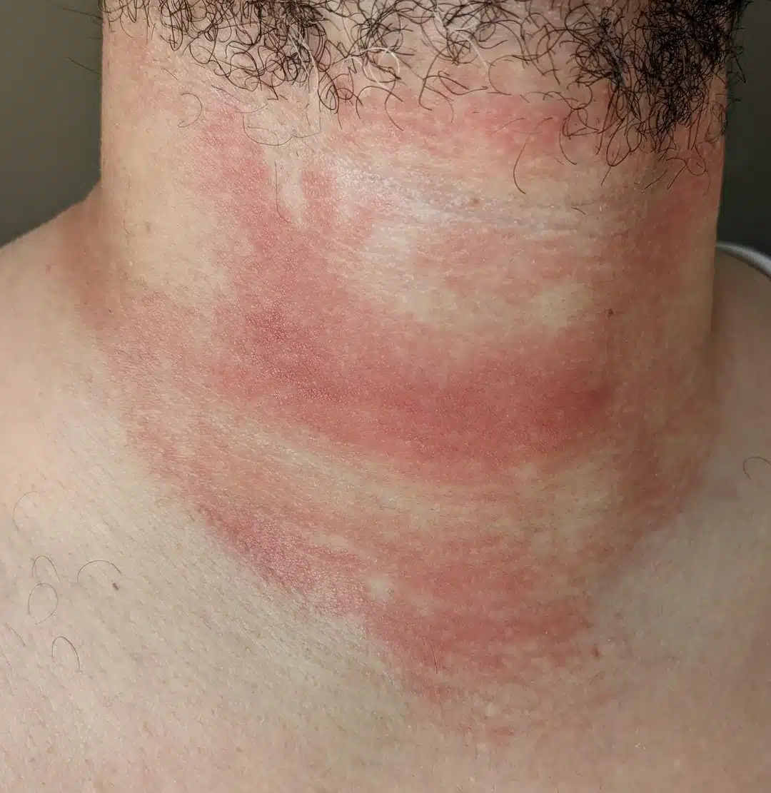 concerns about lymphoma related skin rashes v0 gjzow6v6luh91