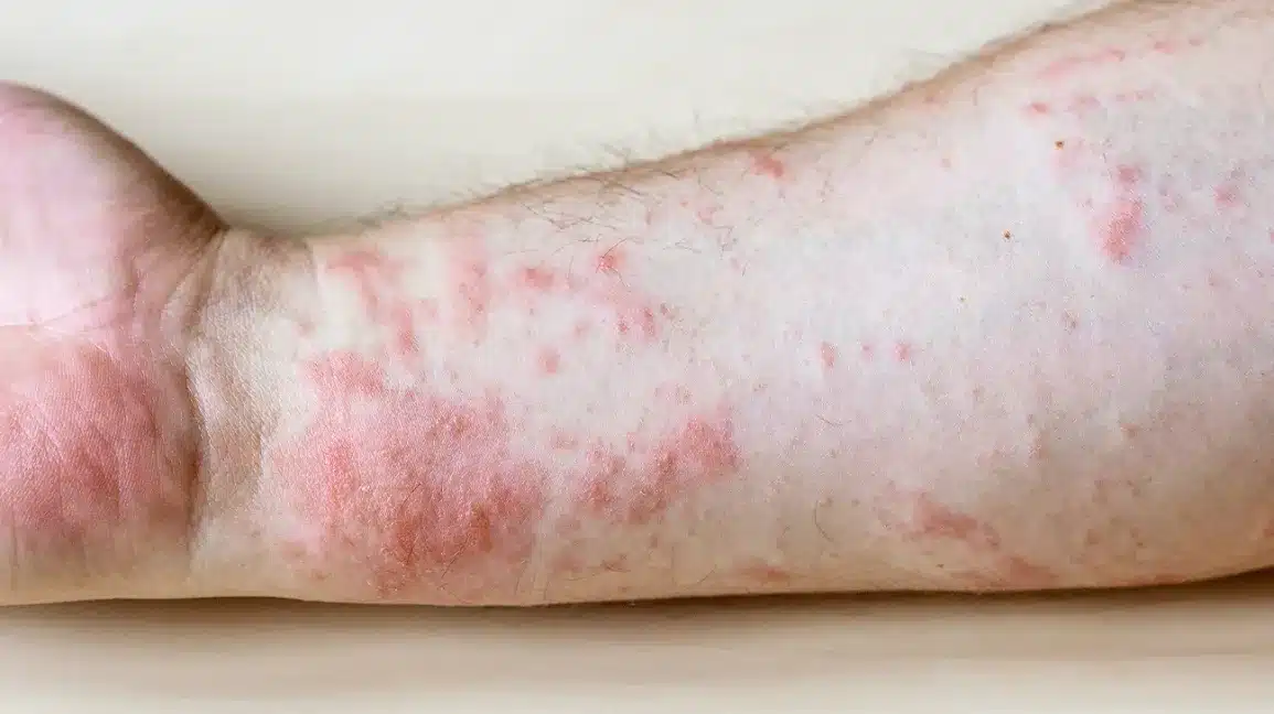 contact dermatitis of the arm body19