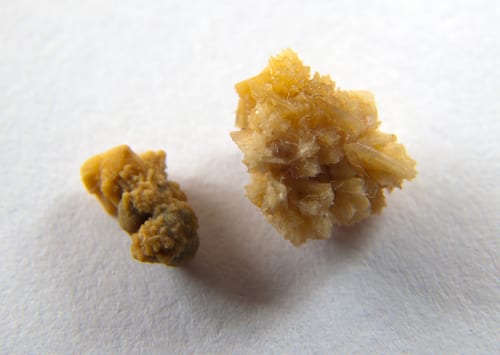 kidney stone prevention tn