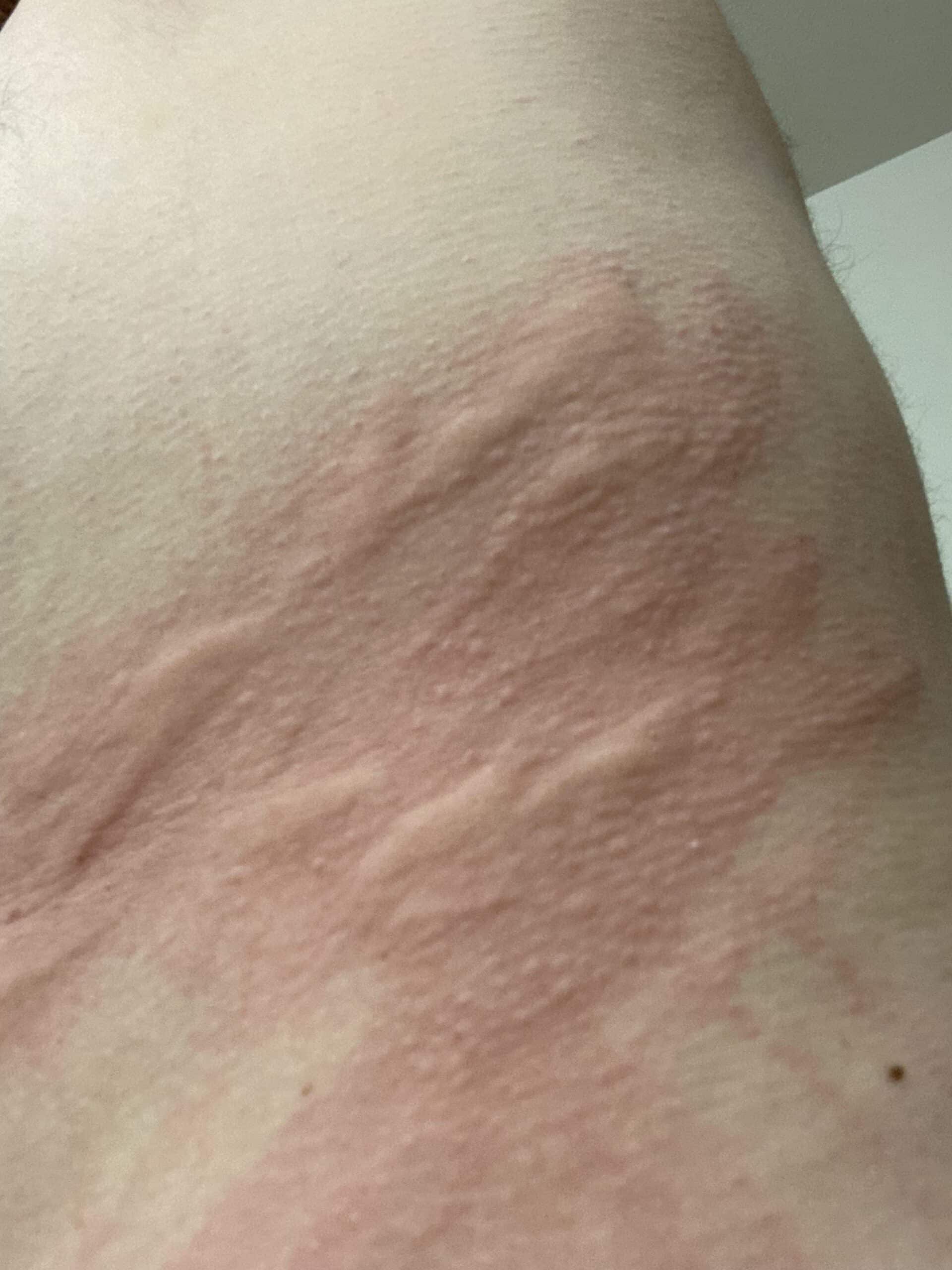 lymphoma rash v0 oudncygxxg3e1 scaled