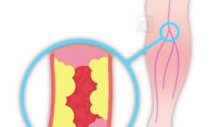 Τα 12 πιο σοβαρά συμπτώματα κακής κυκλοφορίας του αίματος στα πόδια