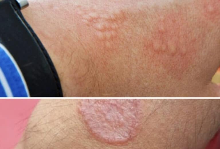 Πώς να μειώσετε τον ερεθισμό του δέρματος: Αίτιες, θεραπείες και συμβουλές πρόληψης