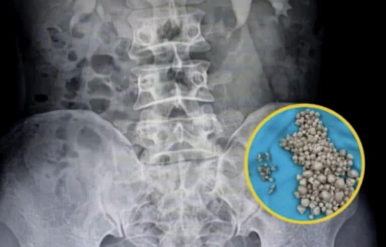 Οι γιατροί σοκαρίστηκαν αφού βρήκαν 300 πέτρες στα νεφρά σε νέα γυναίκα