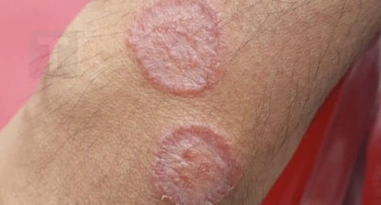 Απλές συμβουλές για να αποφύγετε την μυκητίαση του δέρματος Απλές συμβουλές για να αποφύγετε την μυκητίαση του δέρματος