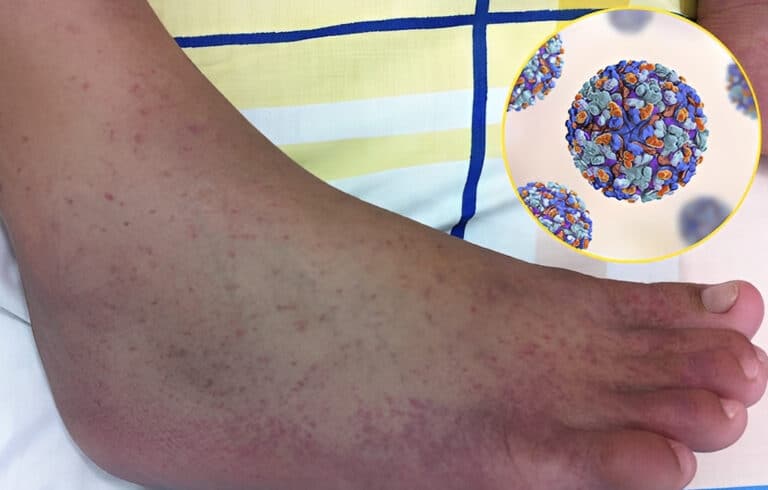 «Καμπανάκι» επιστημόνων για τον ιό τσικουνγκούνια – Φόβοι για νέα πανδημία