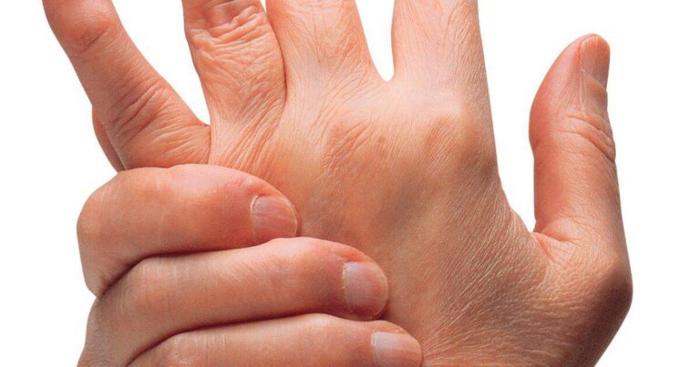 Τι είναι ο λύκος; Οι απαντήσεις που ψάχνετε για αυτή τη δύσκολη και παρεξηγημένη πάθηση