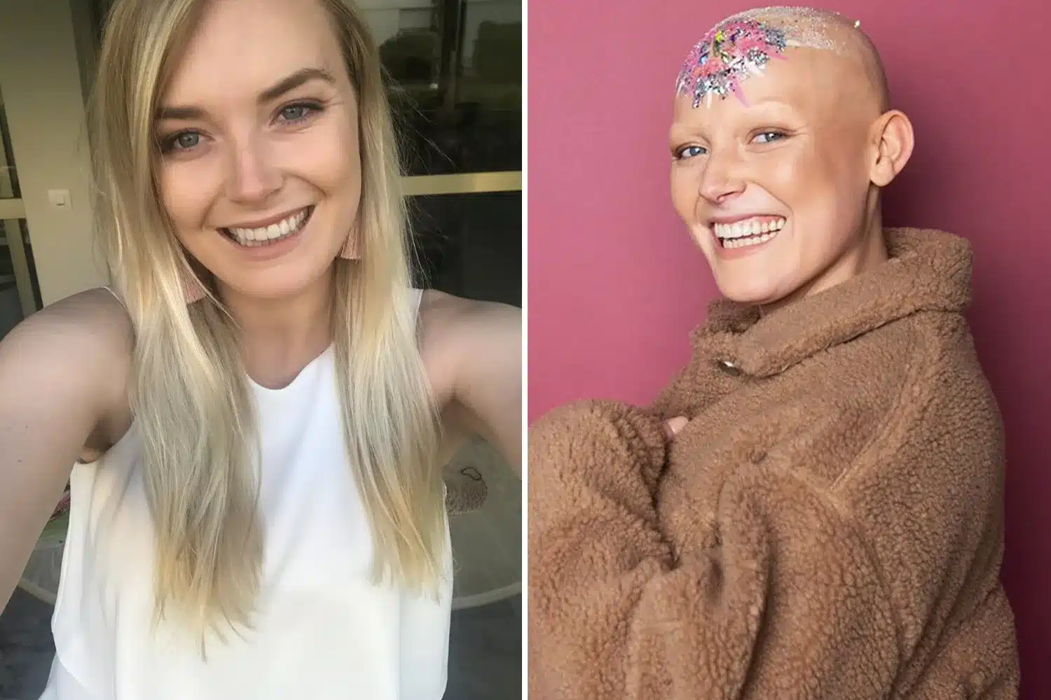 «Αγνόησα τη φαγούρα και άλλα δύο συμπτώματα και στα 20 διαγνώστηκα με καpκίνο» – Τι έπρεπε να είχε προσέξει 1 ac comp cancer georgie swallow