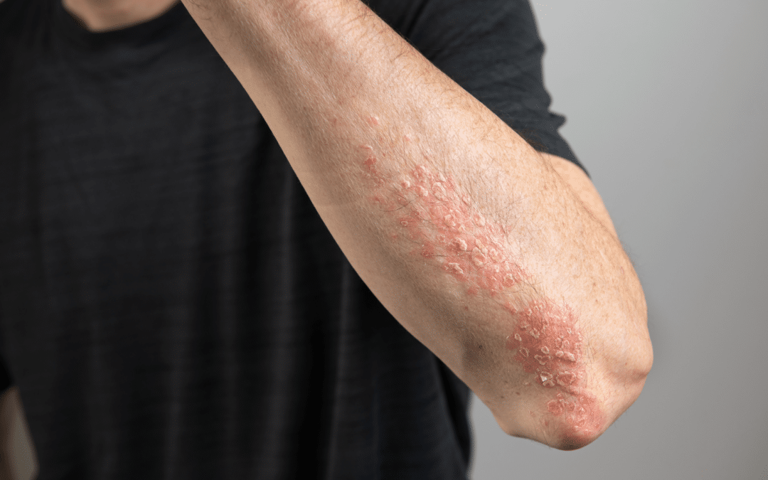 aftoanosa nosimata dermatos 1080x675 1