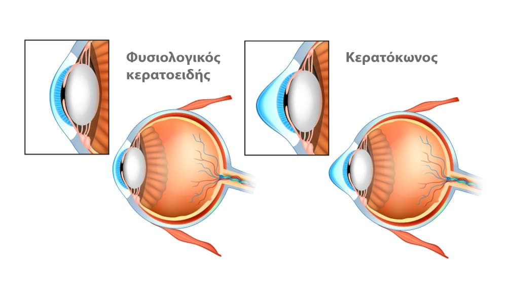 keratokonus 1