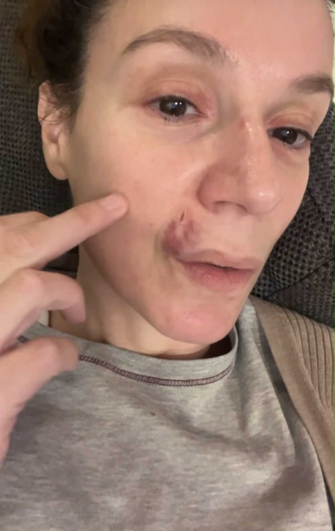 Με μαυρισμένο μάτι και με αίματα στο πρόσωπο η Πέγκυ Τρικαλιώτη 2 peggara