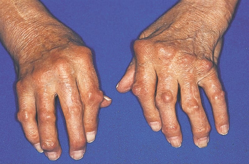 reymatoeidis arthritida