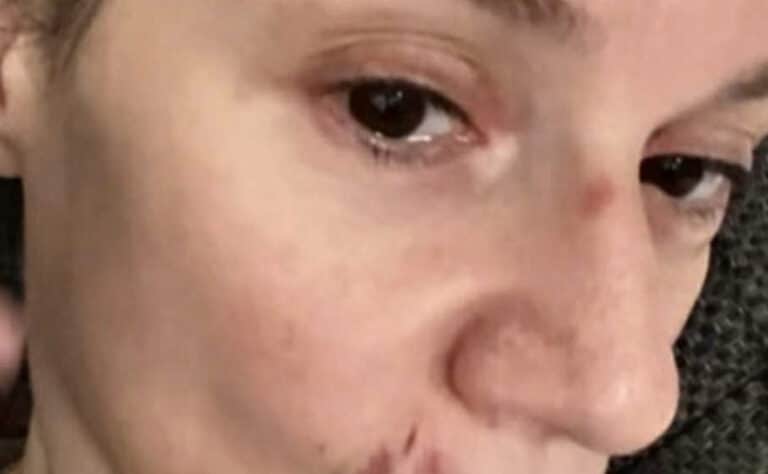 Με μαυρισμένο μάτι και με αίματα στο πρόσωπο η Πέγκυ Τρικαλιώτη