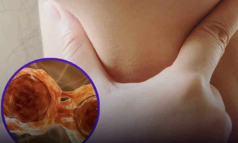 Επιζώντες λεμφώματος μοιράζονται έξι συμπτώματα που είχαν πριν από τη διάγνωση