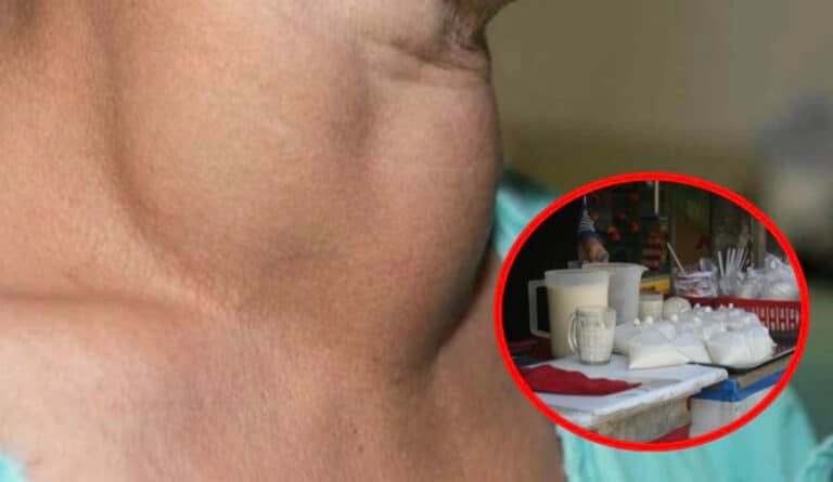 Όζοι θυρεοειδούς: Οι γιατροί συνιστούν να τρώμε λιγότερο από αυτή την τροφή