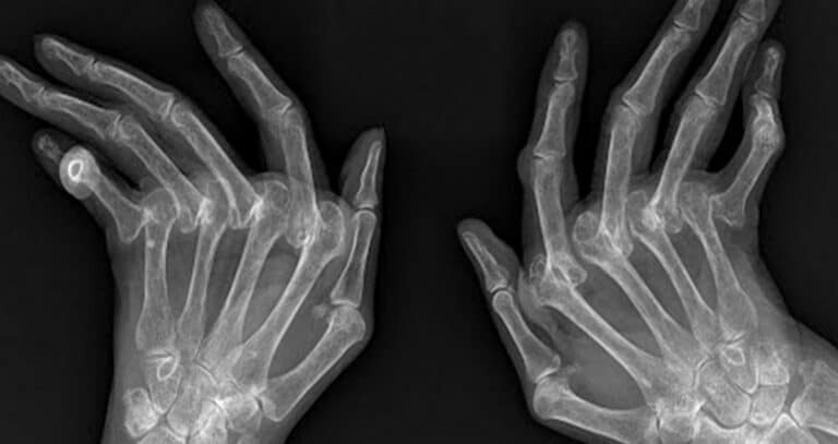 Ρευματοειδής αρθρίτιδα (ΡΑ): 12 συμπτώματα του αυτοάνοσου νοσήματος που πρέπει να ξέρεις