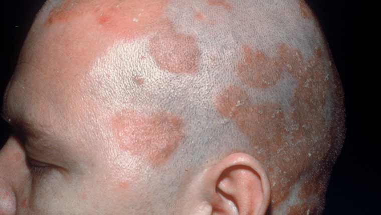 trichotoy kefalis featured article