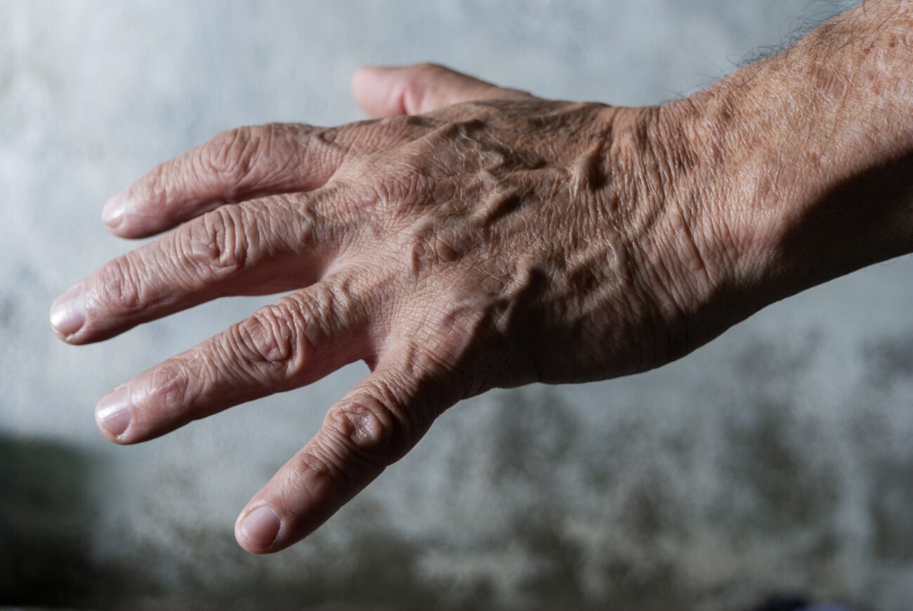 why do i have veiny hands scaled 1