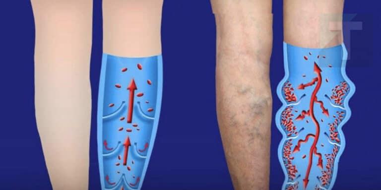 Κουραστήκατε από την κακή κυκλοφορία και τους κιρσούς; Δοκιμάστε αυτά τις 6 αποτελεσματικές συμβουλές 