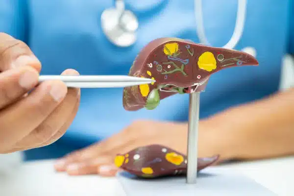 Λίπος στο συκώτι: Οι 4 χειρότερες τροφές για το λιπώδες ήπαρ, σύμφωνα με ηπατολόγο 2 lipos sykoti