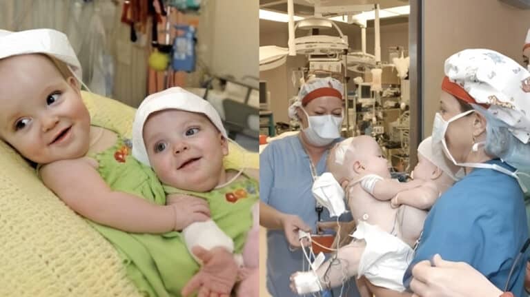 Οι σπάνιες σιαμαίες δίδυμες που γεννήθηκαν το 2003, χειρουργήθηκαν για 24 ώρες και σήμερα είναι δυο όμορφες κοπέλες
