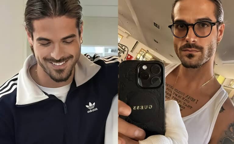 Άρης Μουγκοπέτρος: Δείχνει για πρώτη φορά τα δύο πρόσθετα δάχτυλα μετά τον ακρωτηριασμό του