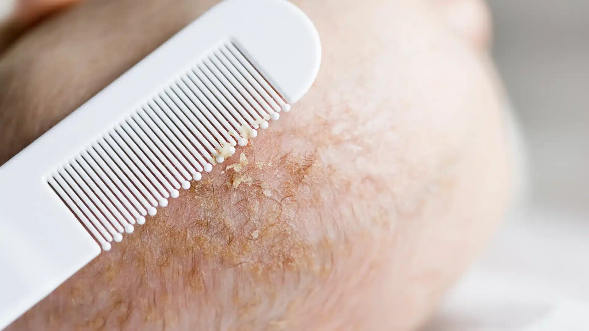 Έβγαινα με μια γυναίκα που γνώρισα στο σουπερμάρκετ και αφού τελικά πήγα μαζί της ξύπνησα με αυτά στο πρόσωπό μου. Τι είναι αυτό; 1 cradle cap.d0bnd ek z1klen2