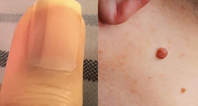 15 ύπουλα πρώιμα σημάδια του καρκίνου που οι περισσότερες γυναίκες αγνοούν