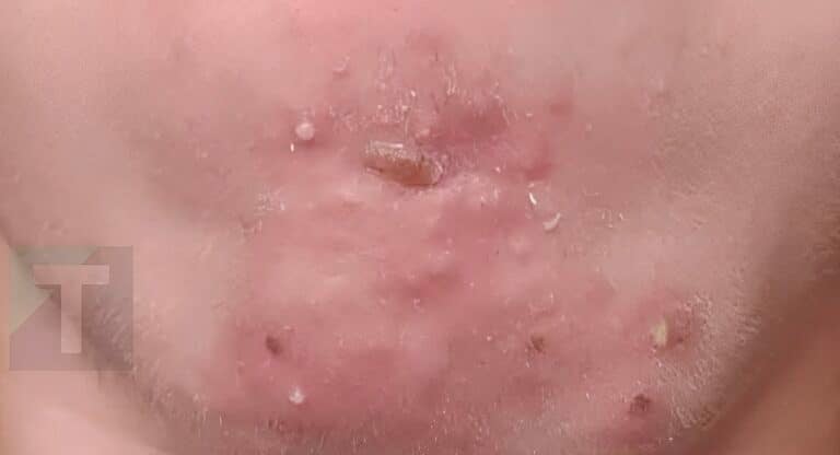 Έβγαινα με μια γυναίκα που γνώρισα στο σουπερμάρκετ και αφού τελικά πήγα μαζί της ξύπνησα με αυτά στο πρόσωπό μου. Τι είναι αυτό;