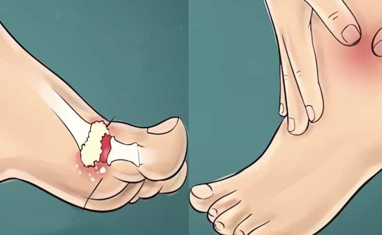 Ποιες τροφές ανεβάζουν επικίνδυνα το ουρικό οξύ και τι πρέπει να προσέχετε