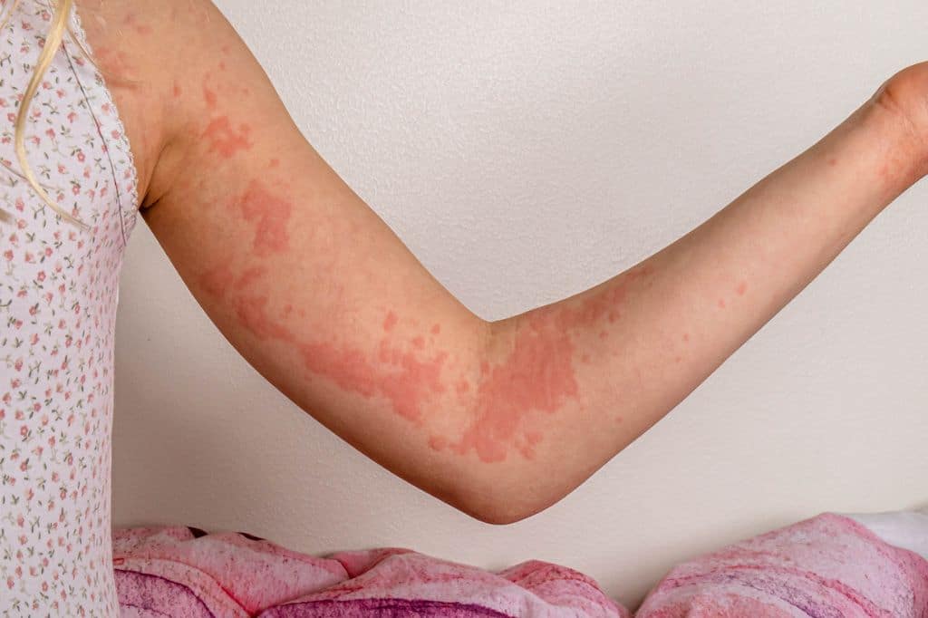 what to do for hives and why they happen