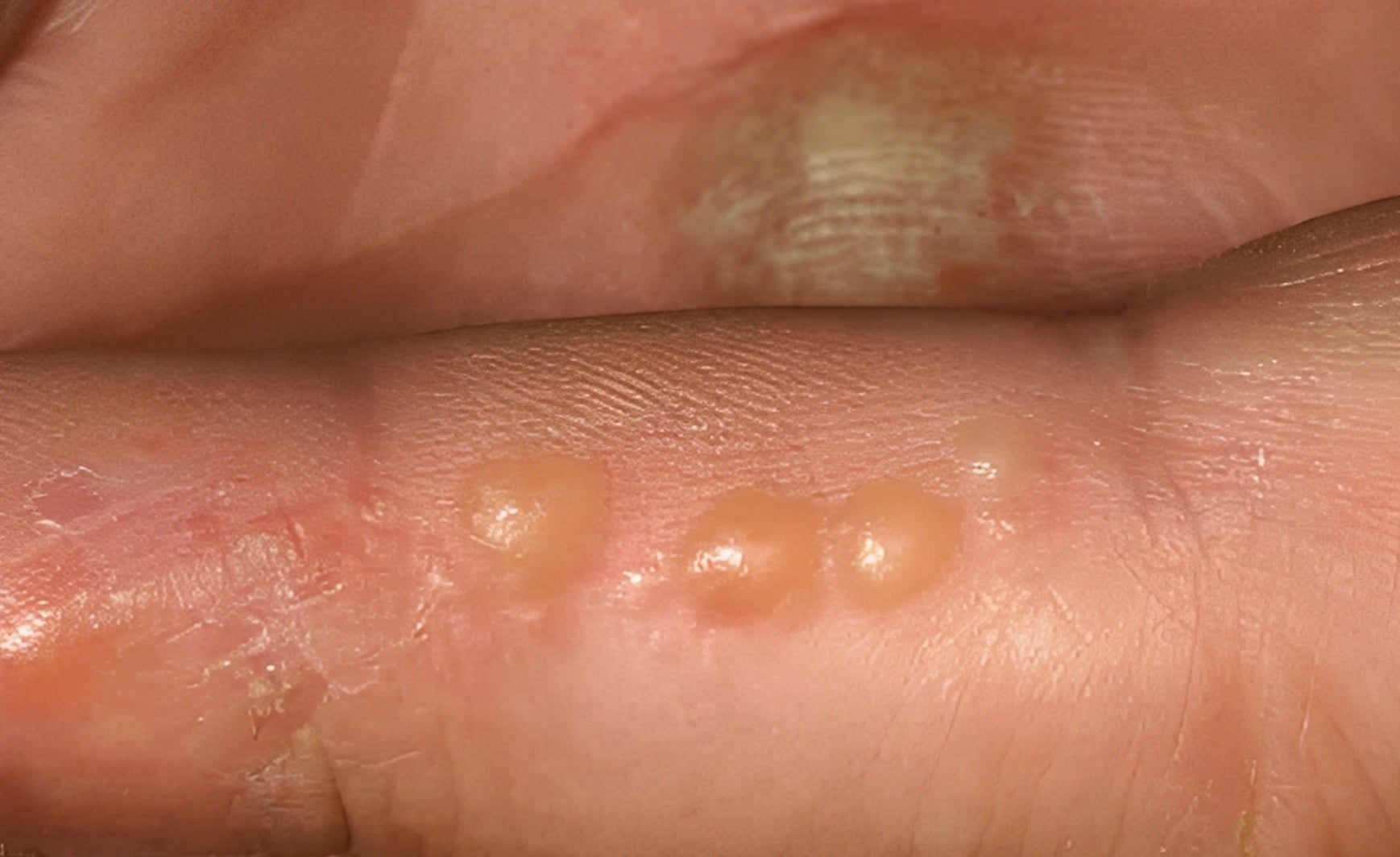 Τα δάχτυλα του συζύγου είναι καλυμμένα με αυτές τις μικροσκοπικές φουσκάλες νερού. Δεν μπορεί καν να πληκτρολογήσει για τη δουλειά 3 1 76