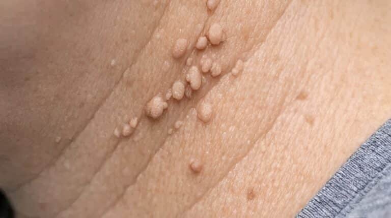 Αυτά τα μικρά δερματικά θηλώματα εμφανίζονται συνεχώς γύρω από τον λαιμό μου και δεν θα δω τον γιατρό μου για εβδομάδες. Τι μπορώ να κάνω άμεσα;