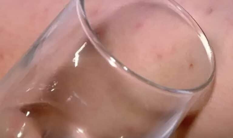 Το σημάδι στο δέρμα από μηνιγγίτιδα: Πώς γίνεται το «τεστ με το ποτήρι»