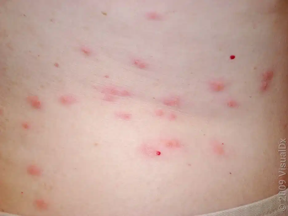bed bug bites treatment 4283343