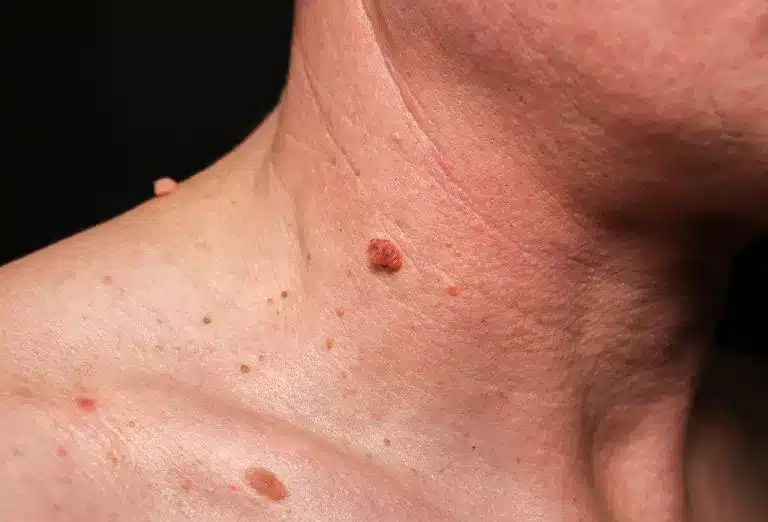 big birthmark man s skin medical health photo papillomas neck scaled 1 768x522 1