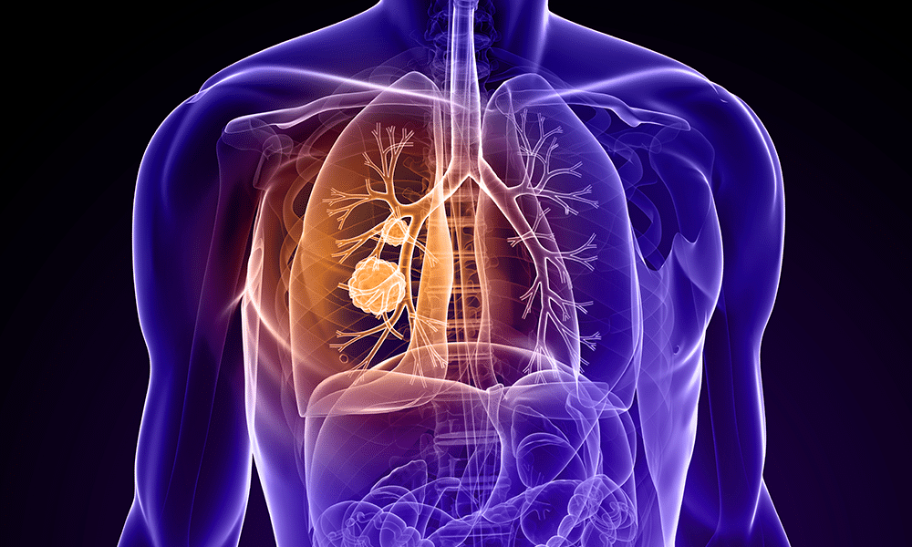 lung cancer illustration feature dtm
