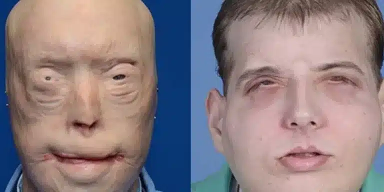 Ολική μεταμόσχευση προσώπου – Παραμορφωμένος πυροσβέστης απέκτησε νέα ζωή