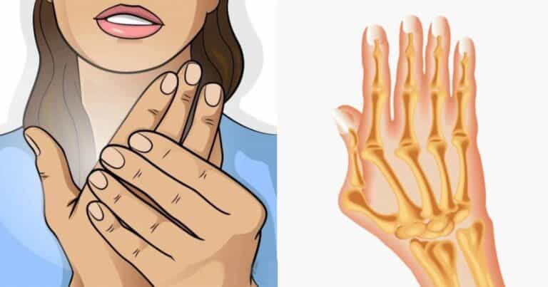 Ρευματοειδής αρθρίτιδα: Τα συνήθη συμπτώματα- Τι να τρώτε και τι να αποφεύγετε