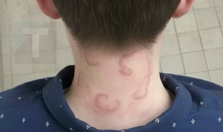 Ο 8χρονος γιος μου έχει αυτό εδώ και 2 μήνες συνεχόμενα και έχει χειροτερέψει από την πρώτη φορά που το είχε… Τι είναι;