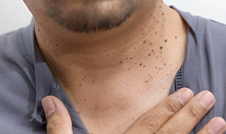 11 ύπουλα σημάδια υψηλού σακχάρου στο αίμα – Ποια είναι τα πιο συνηθισμένα