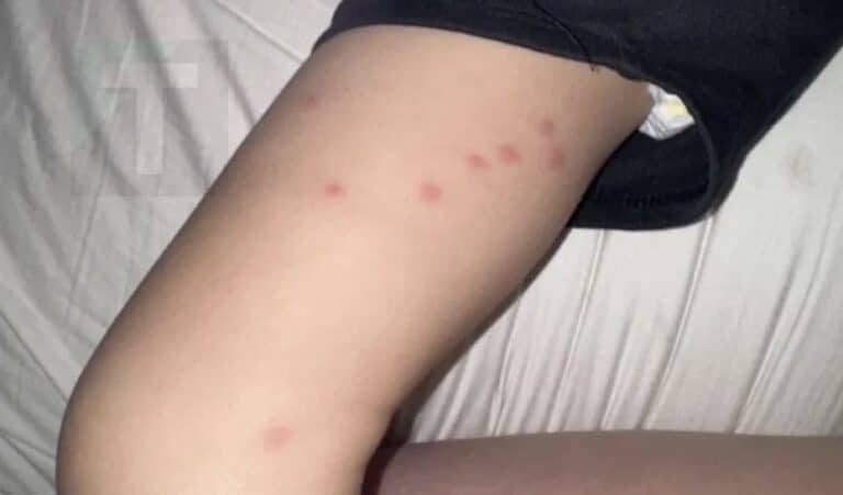 Το νήπιο μου ξύπνησε με αυτά τα εξογκώματα στο πάνω μέρος των μnρών του