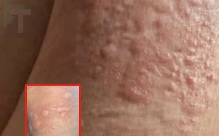 Αυτό που νόμιζε ότι ήταν μια απλή αλλεργία αποδείχθηκε κάτι πολύ πιο ανησυχητικό, όταν οι γιατροί έκαναν τη διάγνωσή τους