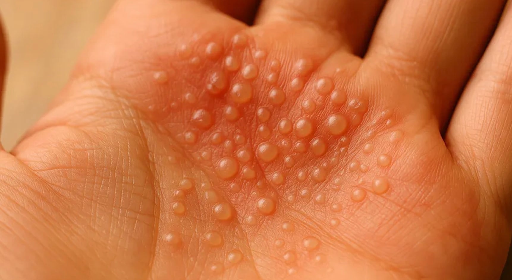 Τα δάχτυλα του συζύγου είναι καλυμμένα με αυτές τις μικροσκοπικές φουσκάλες νερού. Δεν μπορεί καν να πληκτρολογήσει για τη δουλειά 1 stigmiotypo othonis 2026 02 17 03.12.23