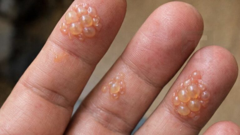 Τα δάχτυλα του συζύγου είναι καλυμμένα με αυτές τις μικροσκοπικές φουσκάλες νερού. Δεν μπορεί καν να πληκτρολογήσει για τη δουλειά