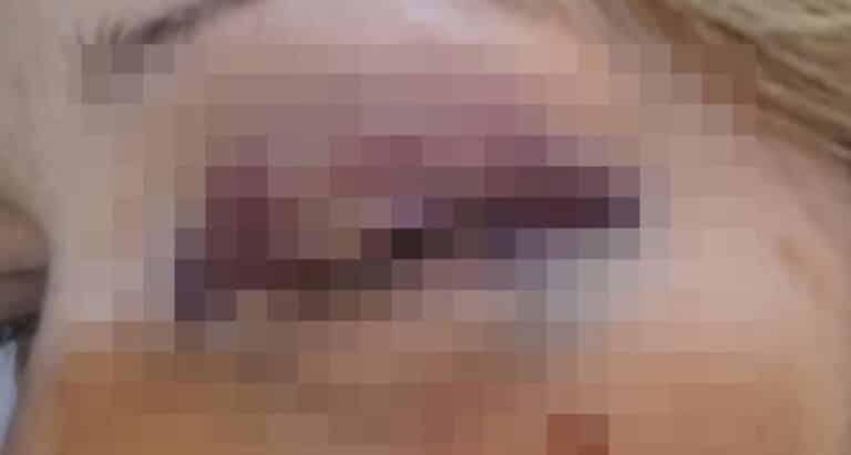 Λευκάδα: «Θα το ξαναέκανα και με μωβ μάτι» λέει η δασκάλα μετά τον άγριο ξυλοδαρμό