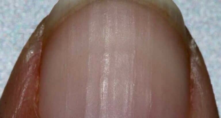 Αν παρατηρείτε ραβδώσεις στα νύχια σας, δείτε τι σημαίνουν