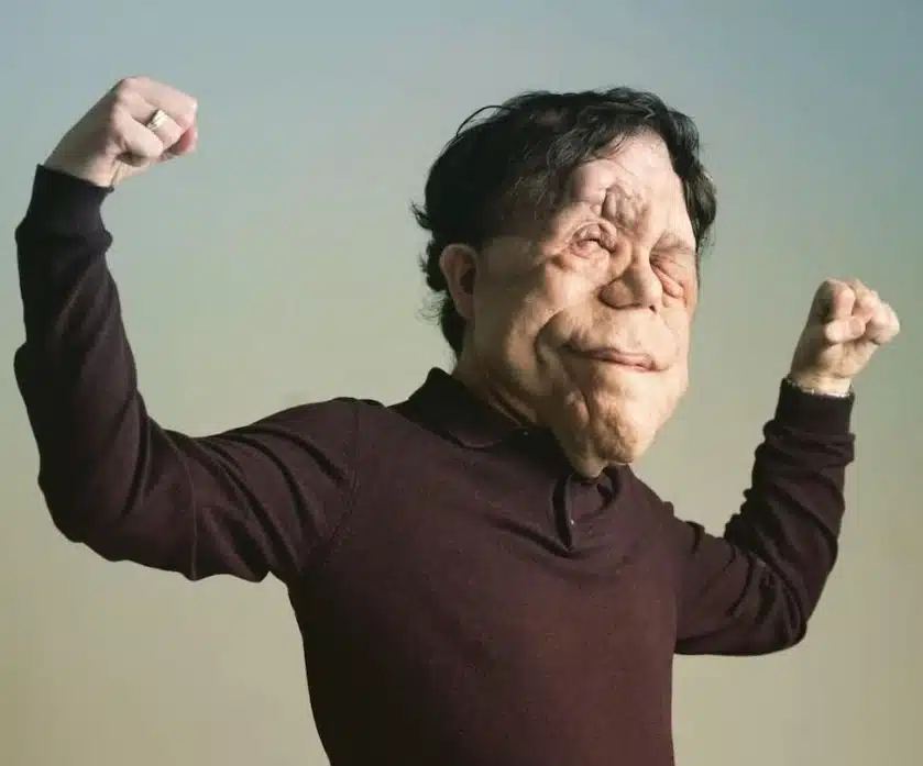 Χαμός στα Όσκαρ: Πασίγνωστος ηθοποιός εμφανίστηκε με αυτό το πρόσωπο και… πάγωσαν όλοι – Η σπάνια αρρώστια που τον «χτύπησε» 1 1773647848748 392251712 22